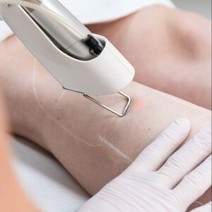 Huidzorg Laserklinieken Den Bosch image 6